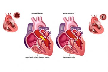 تنگی دریچه آئورت قلب چیست و چطور آن درمان را کنیم