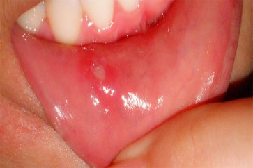 درمان فوری و قطعی زخم و آفت دهان